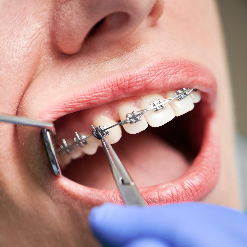 Dentist placing braces on female patient teeth. Cosmetic Dentistry