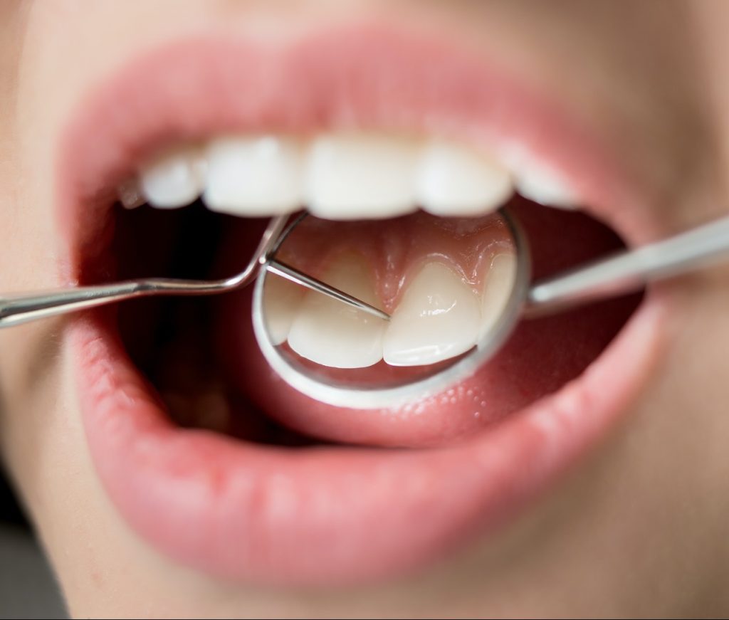 Macro shot of woman having dental check up in dental clinic. Dentist examining a patient's teeth