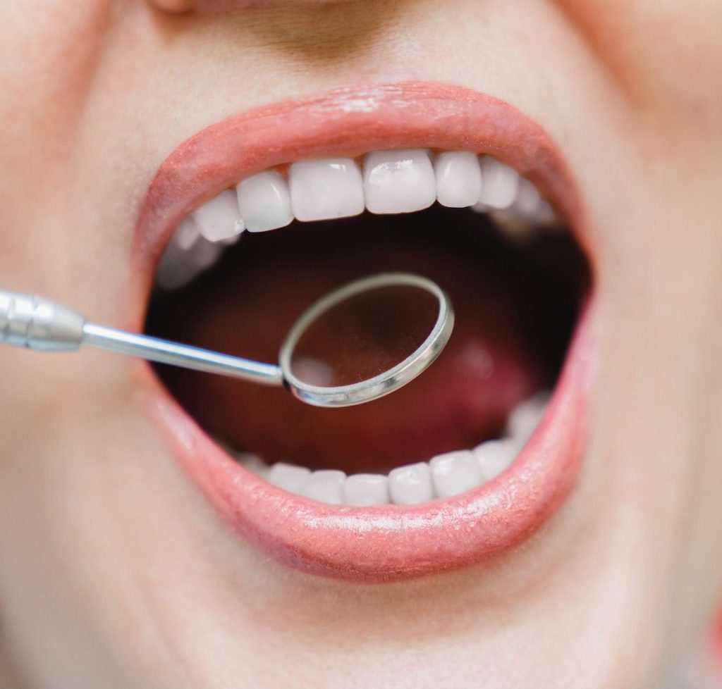 Patient`s mouth with perfect teeth tooth at dental checkup. Whitening. Stomatologist using mirror Restorative Dentistry